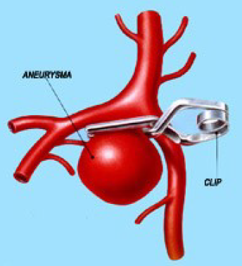 clippen aneurysma