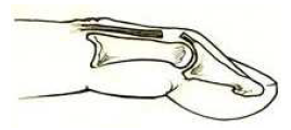 mallet vinger 