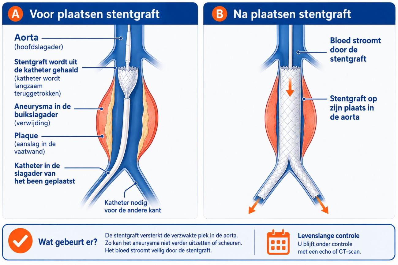EVAR procedure