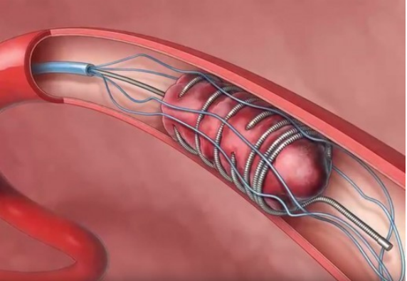Behandeling herseninfarct of TIA