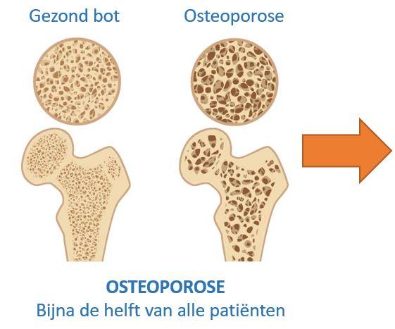 Gezond bot en osteoporose