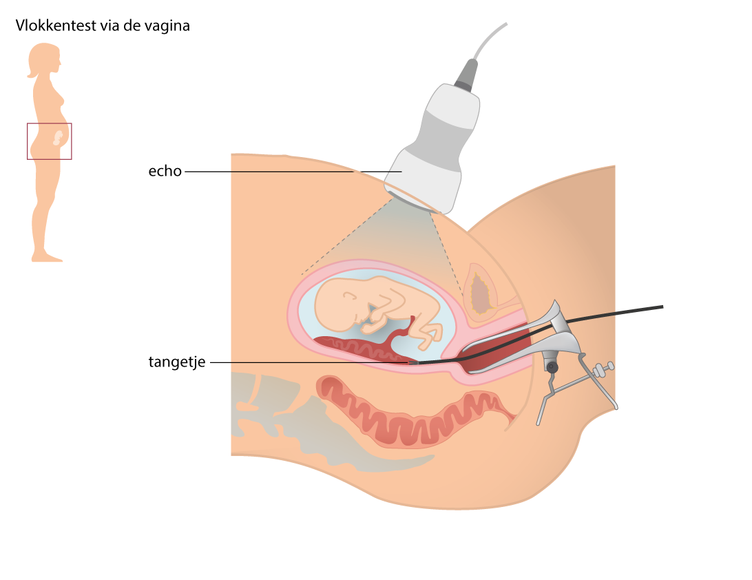 vlokkentest via de vagina