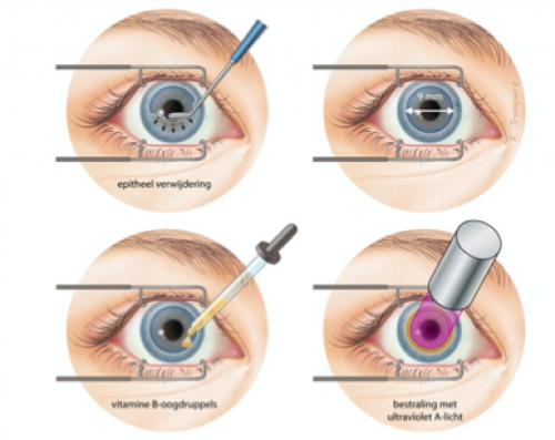 Vier stappen tijdens de corneale crosslinking operatie.