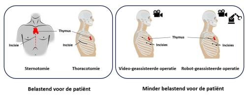 Robotoperatie zwezerik (thymectomie) Maastricht UMC+ M