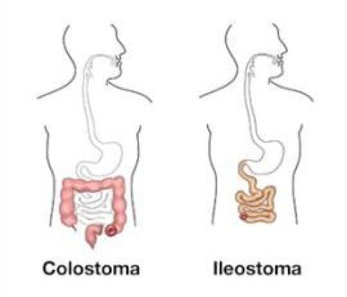 2 soorten stoma