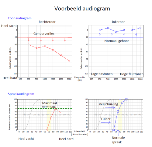 Voorbeeld audiogram