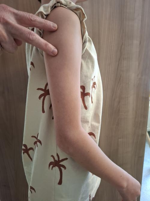 Voor vaccinatie: op de bovenarm (tussen de beide vingers)