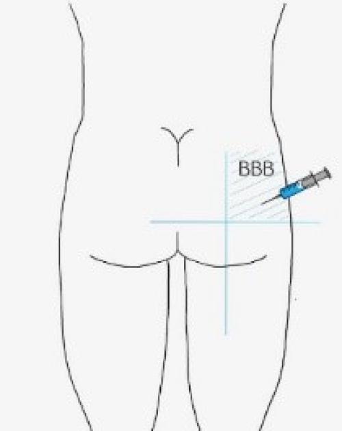 Injectieplaats in de bil