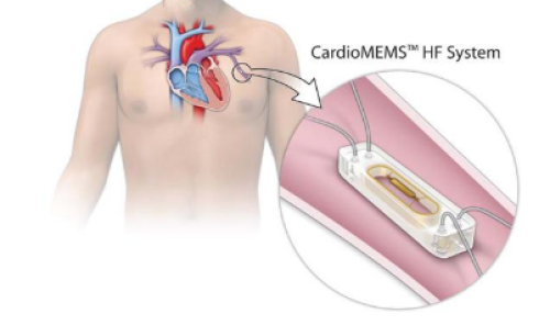 Foto plaatsing CardioMEMS HF 