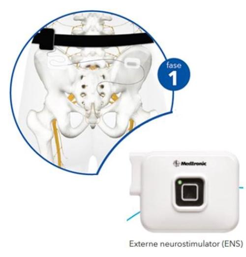 Fase 1 neurostimulator